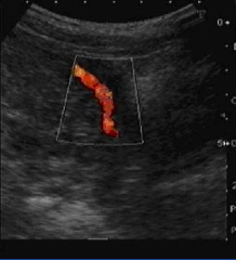obr. dopplerovské vyšetření děložní tepny