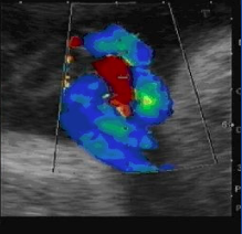 obr. dopplerovské vyšetření pupečníkové tepny a žíly plodu
