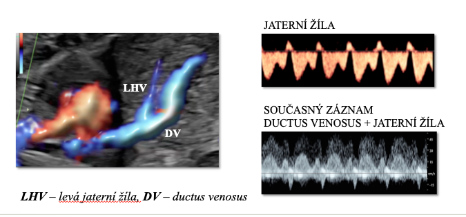 obr. dopplerovské vyšetření ductus venosus