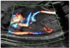 obr. dopplerovské vyšetření ductus venosus