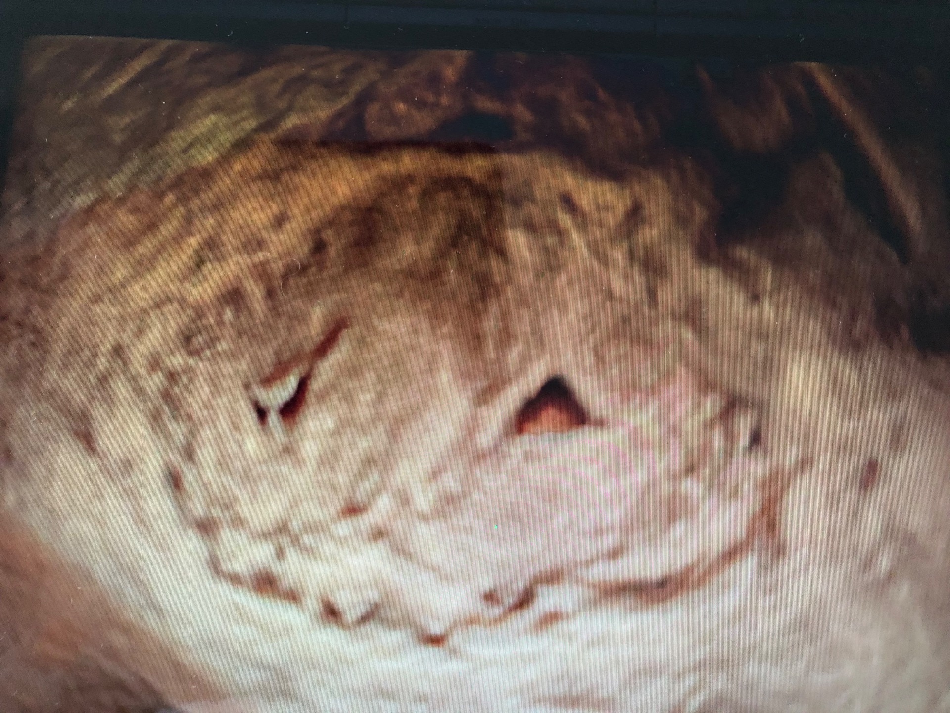 obr. dva děložní čípky u zdvojené dělohy, není zřetelné jejich oddělení