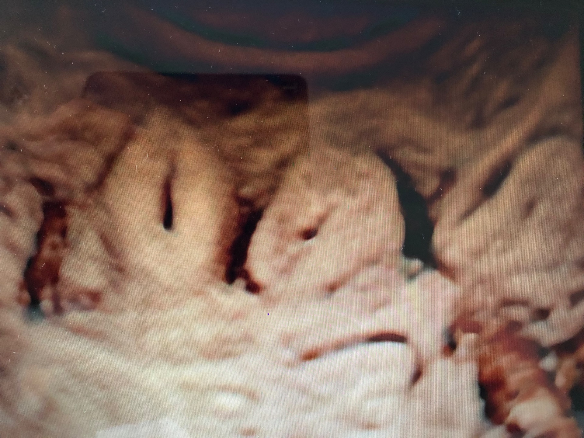 obr. zřetelně odědělené děložní čípky u zdvojené dělohy