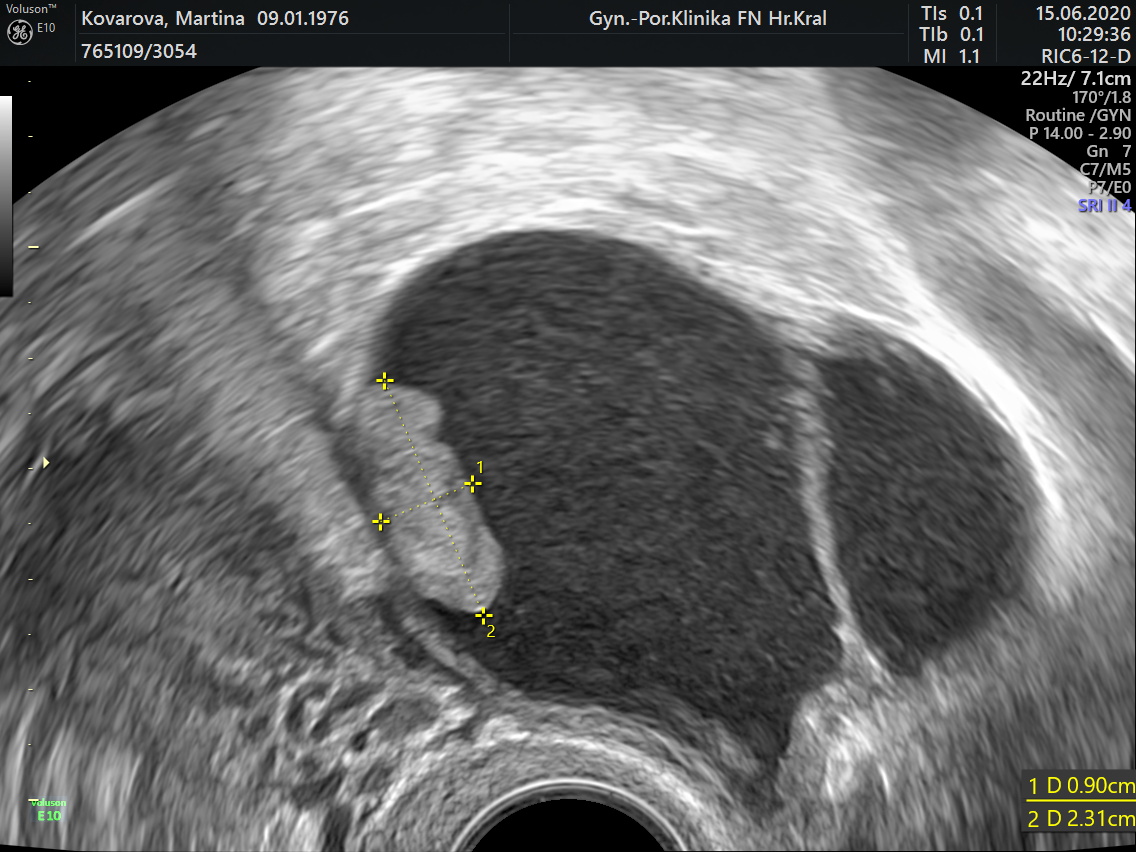 obr. 2D ultrazvuk endometriom se světlobuněčným karcinomem vaječníku